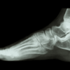 foot xray