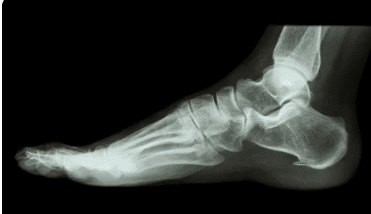 IMPORTANCE OF FOOT X-RAY foot xray